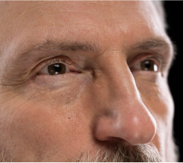 revision rhinoplasty procedure