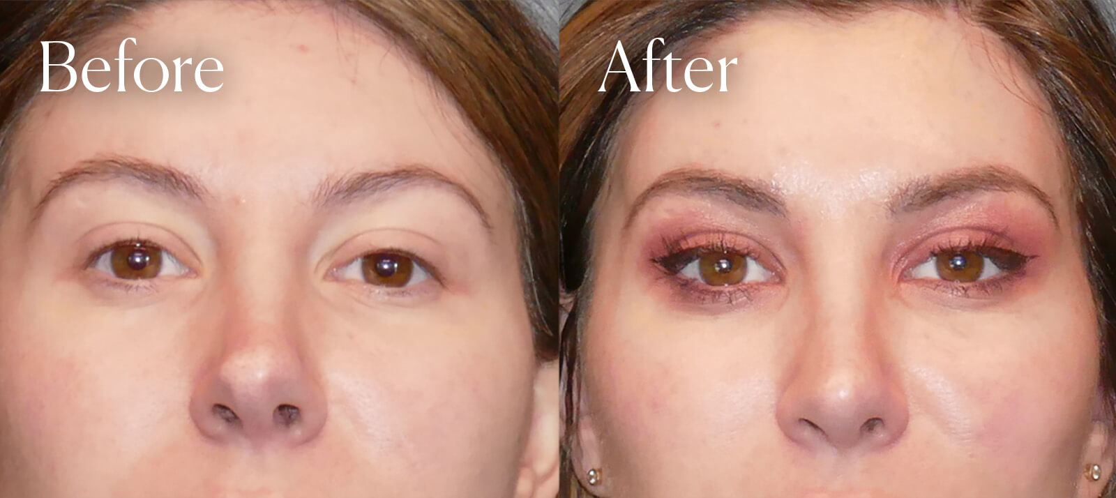 browlift facial procedure