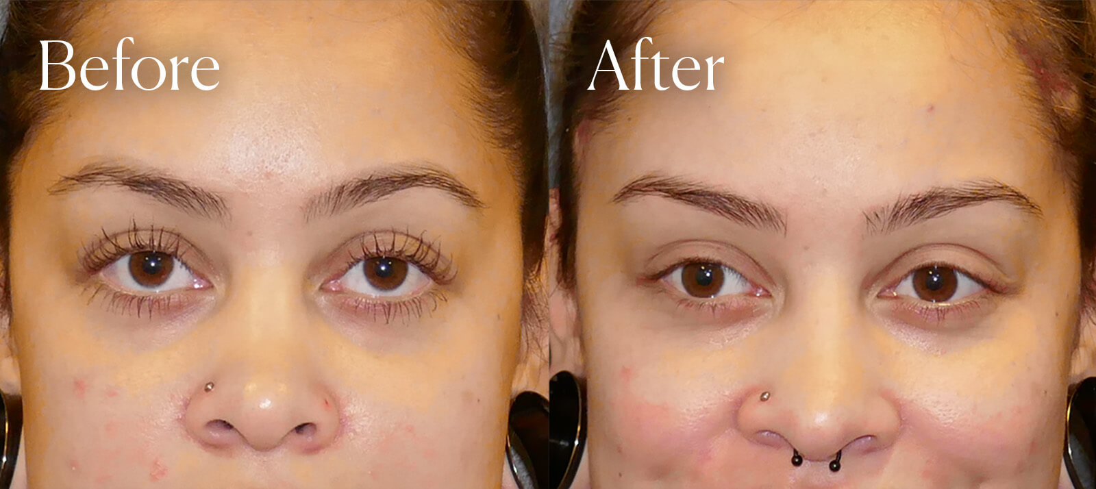 browlift results