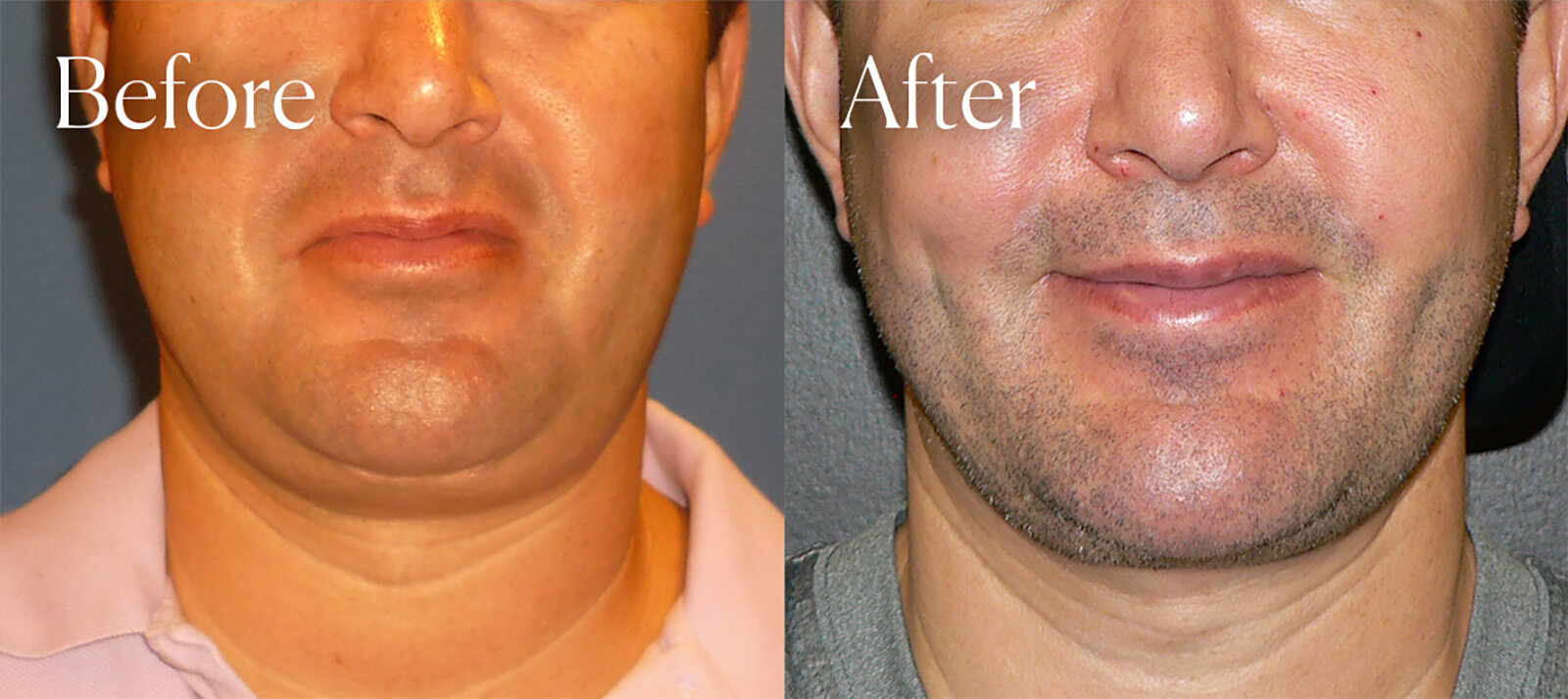 dimpleplasty procedure colorado