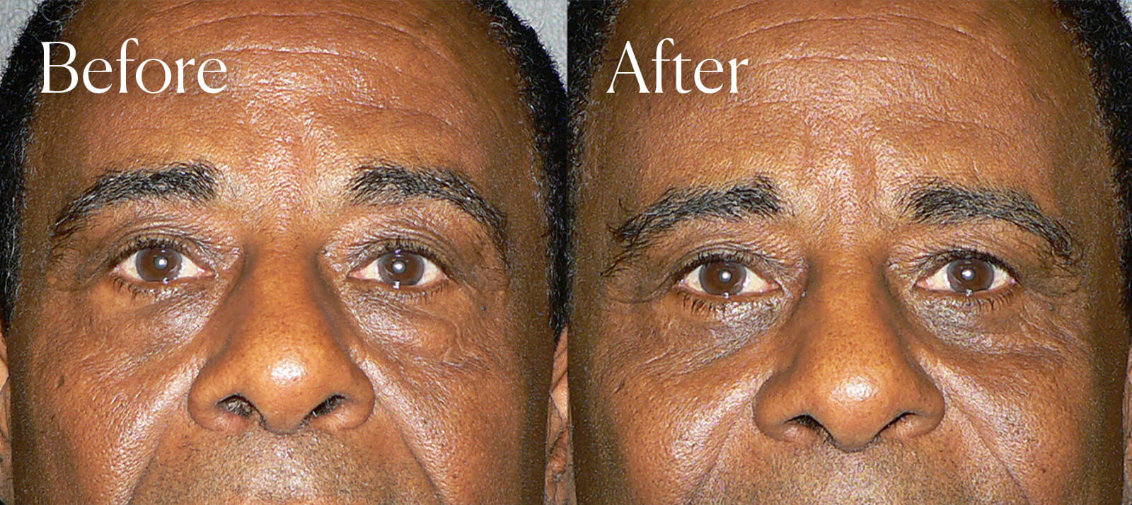 eyelid lift before and after