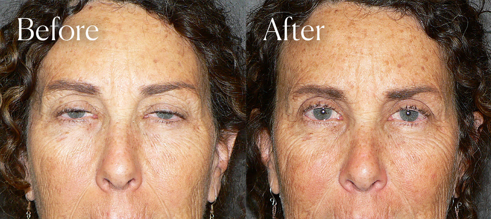 eyelid lift colorado