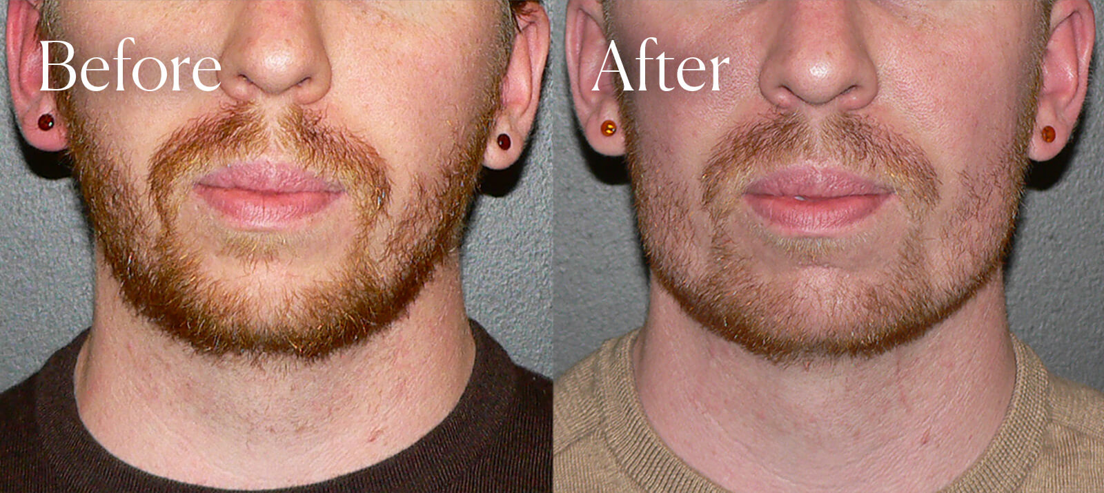 jaw implant before and after