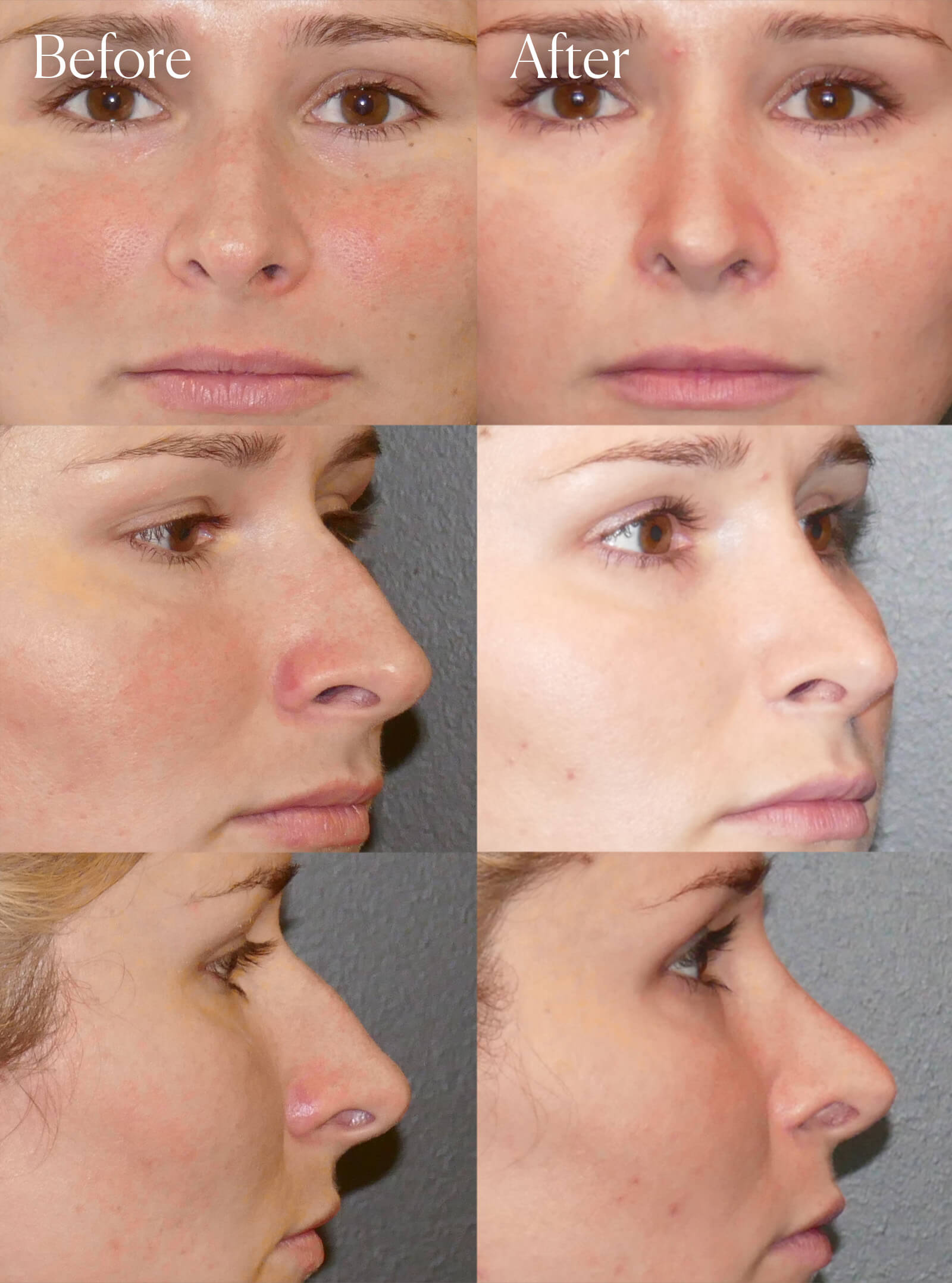 rhinoplasty plastic surgery