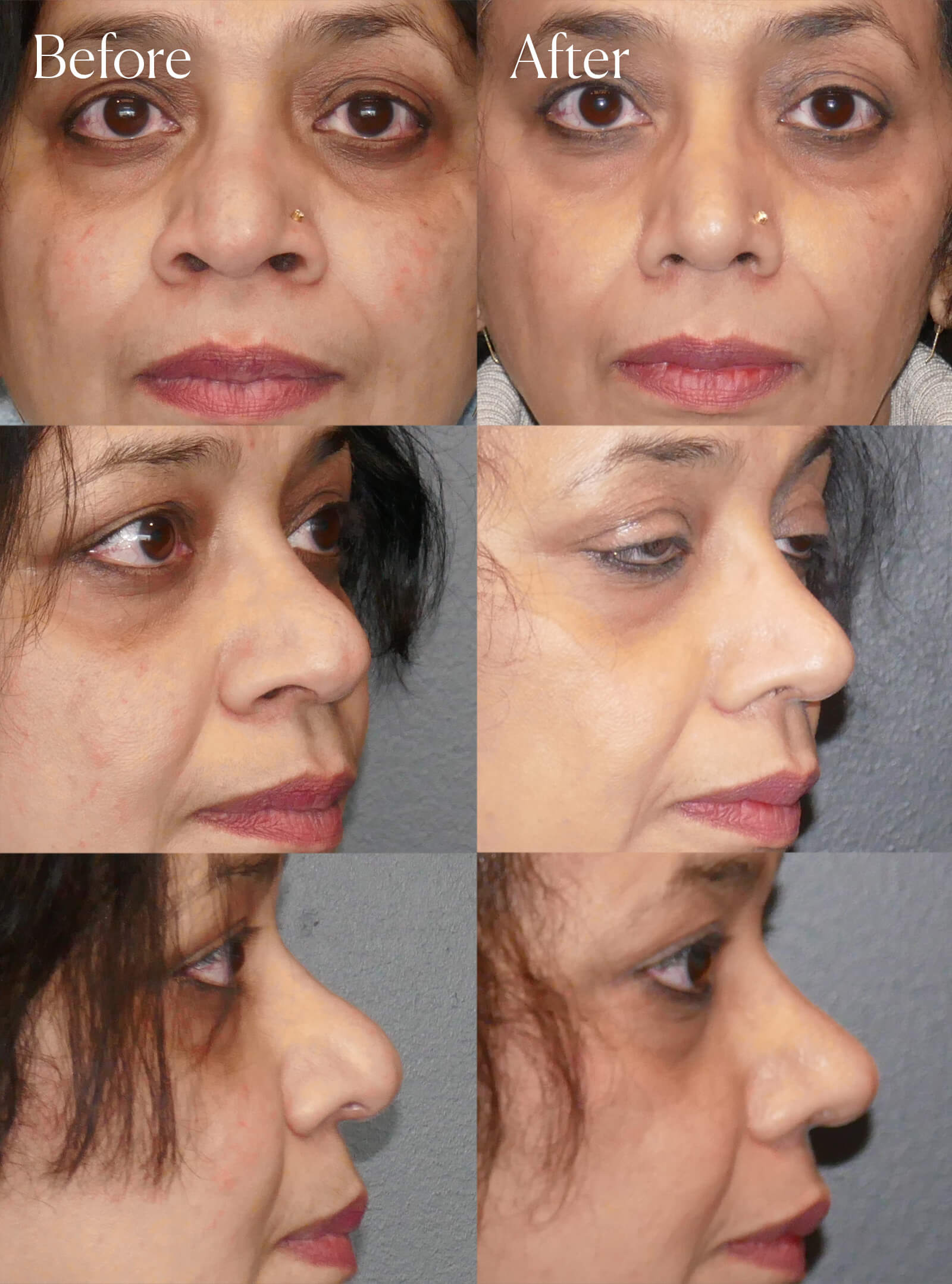 tip rhinoplasty plastic surgery