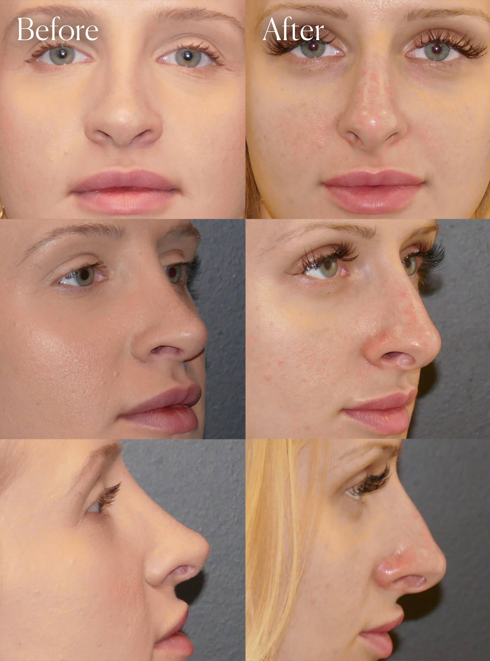 ultrasonic rhinoplasty surgery results