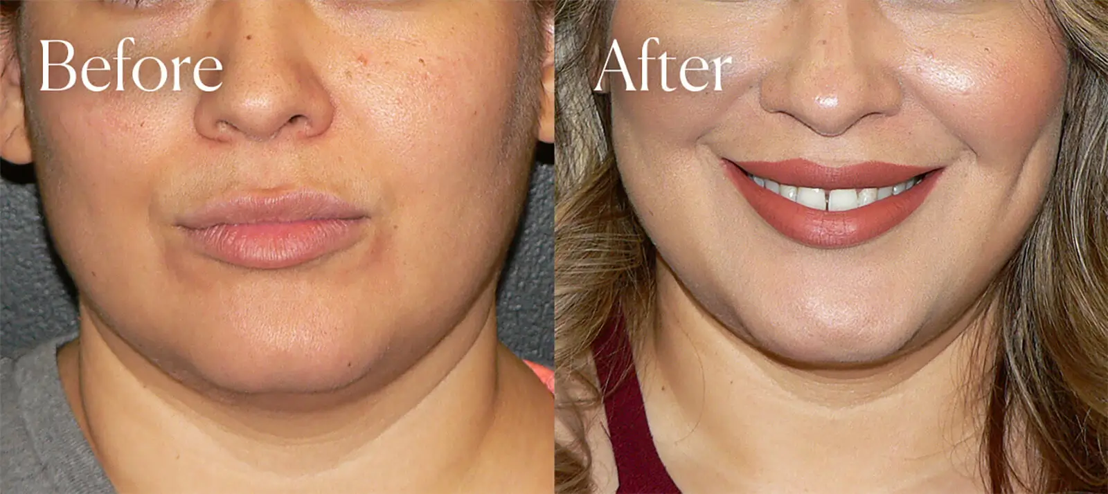 denver dimpleplasty surgery