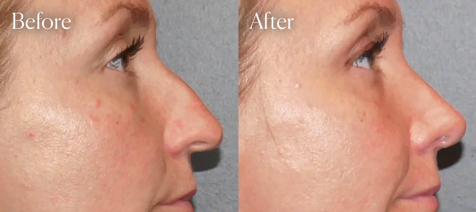 aesthetic-surgery-preservation-ultrasonic-rhinoplasty aesthetic surgery preservation ultrasonic rhinoplasty