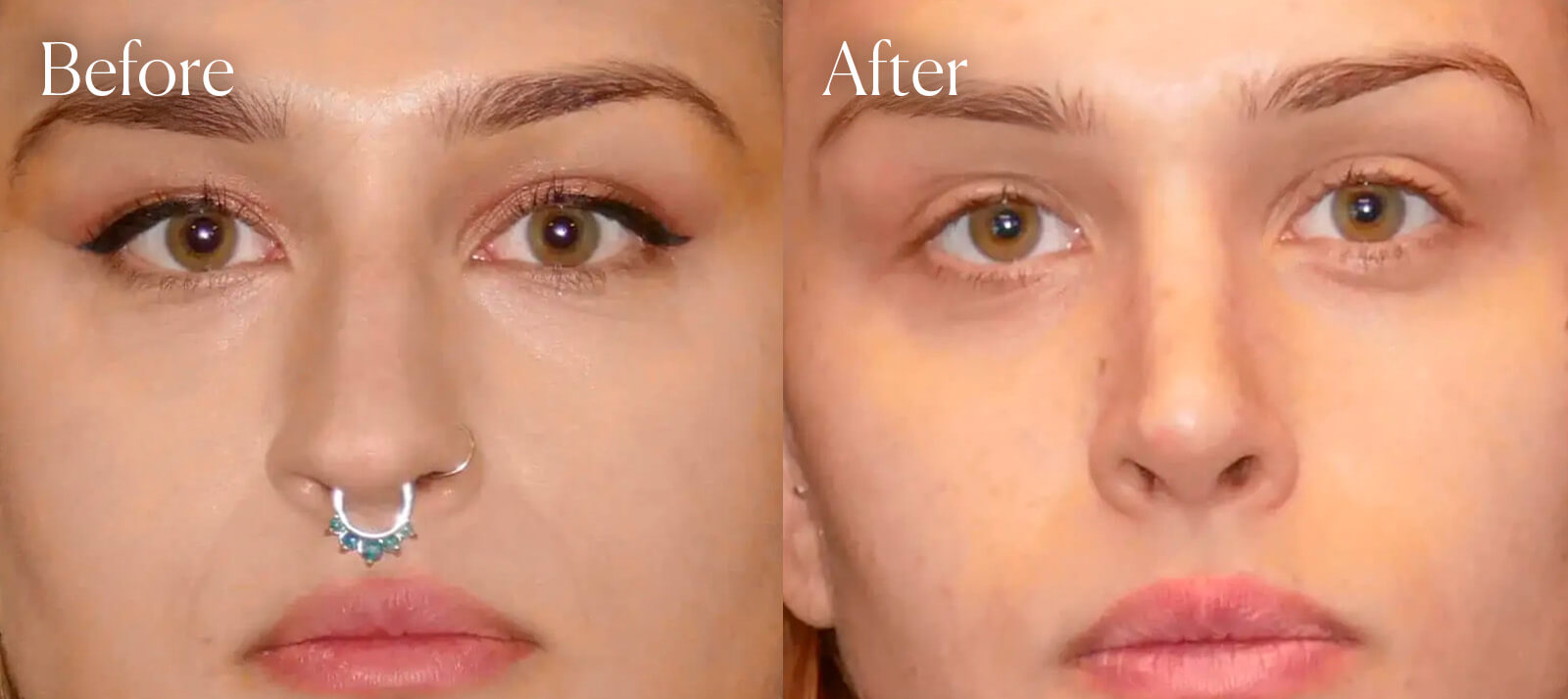 aesthetic-surgery-rhinoplasty aesthetic surgery rhinoplasty