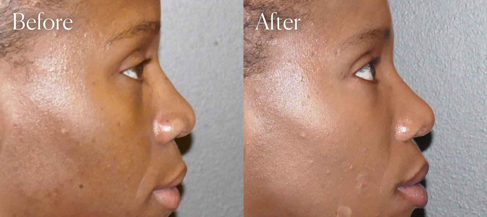 aesthetic-surgery-ultrasonic-ethnic-rhinoplasty aesthetic surgery ultrasonic ethnic rhinoplasty
