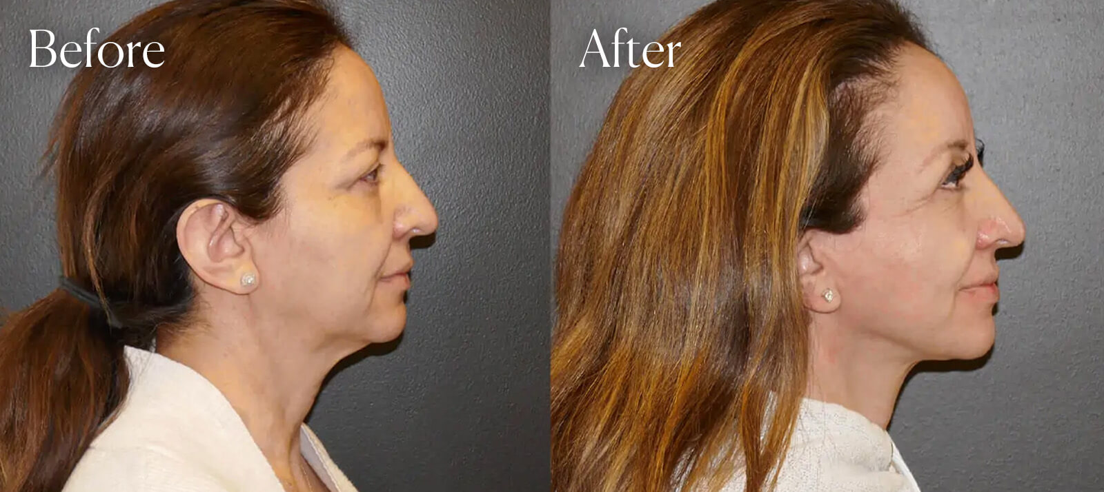 before-after-facelift-colorado before after facelift colorado