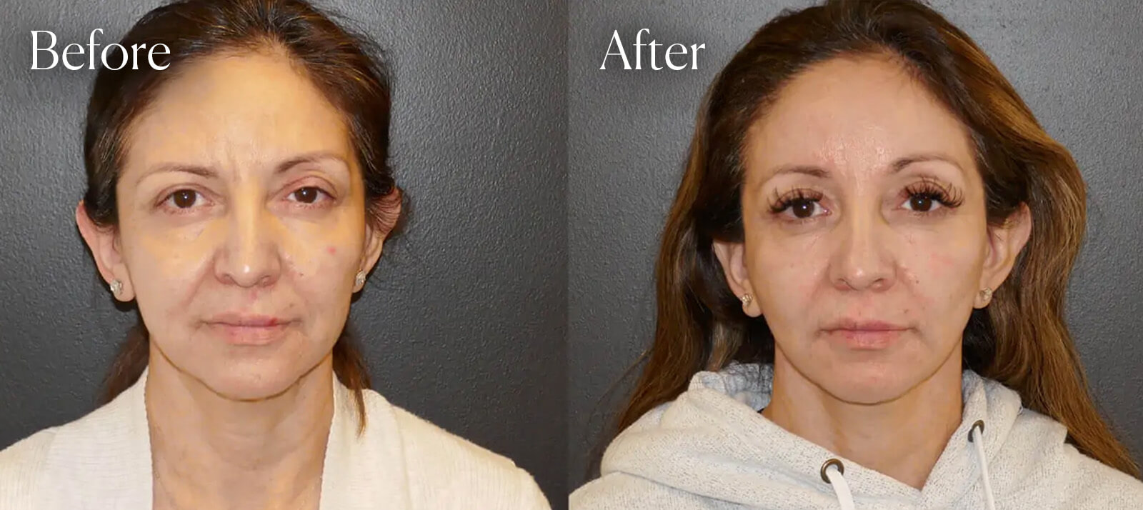 before-after-facelift before after facelift