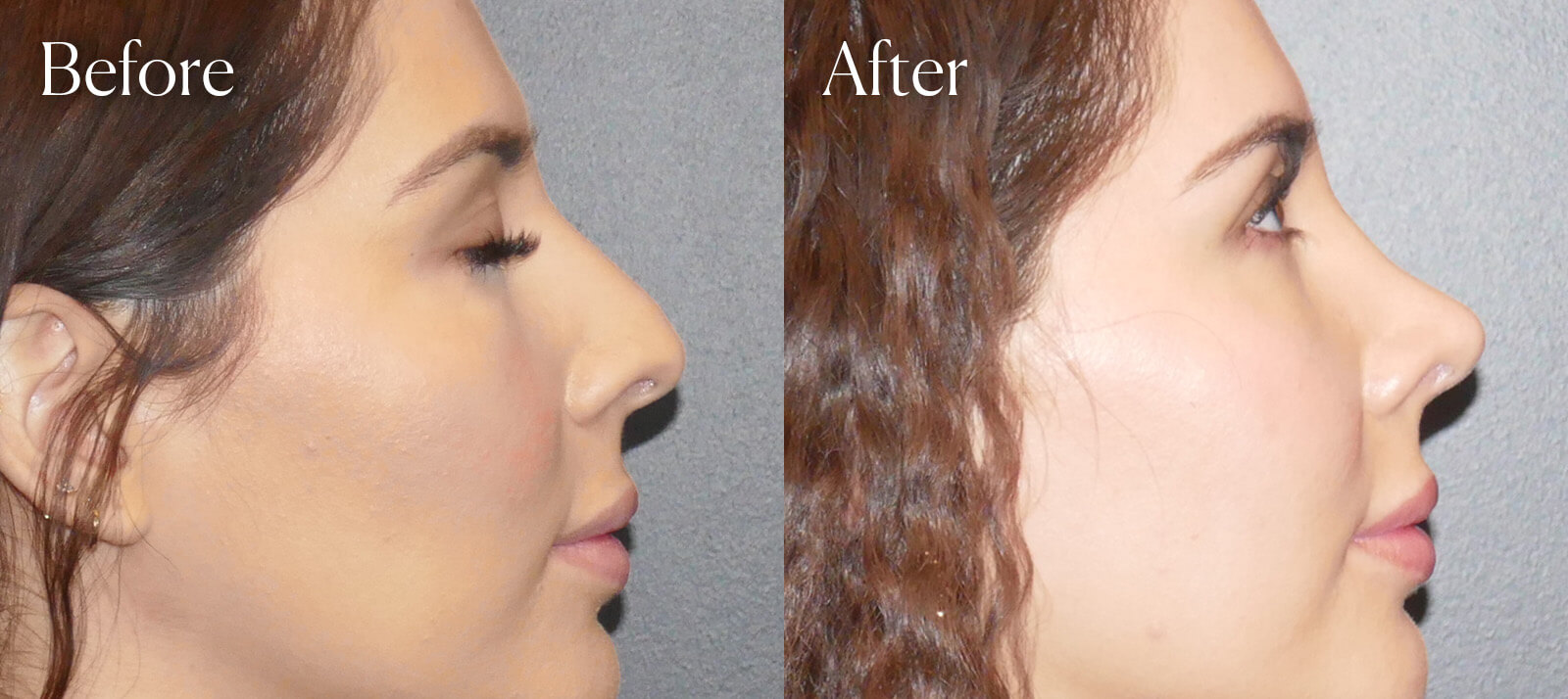 before-and-after-ethnic-rhinoplasty-denver before and after ethnic rhinoplasty denver