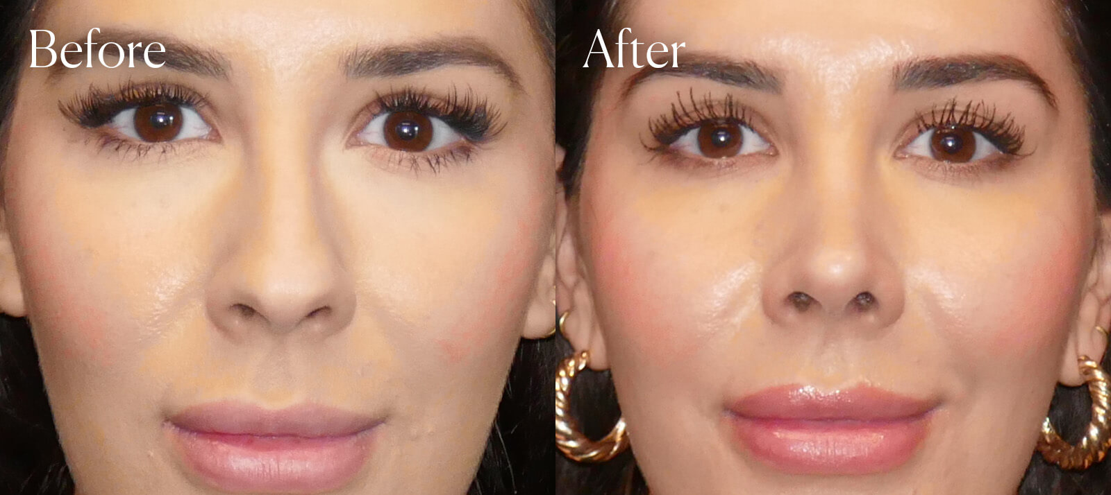 before-and-after-ethnic-rhinoplasty before and after ethnic rhinoplasty
