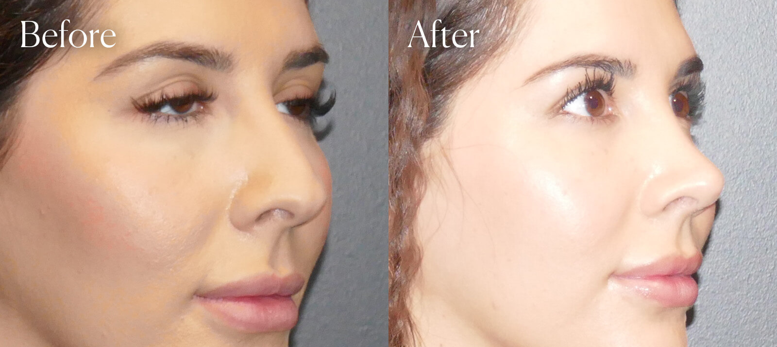 before-and-after-results-ethnic-rhinoplasty before and after results ethnic rhinoplasty