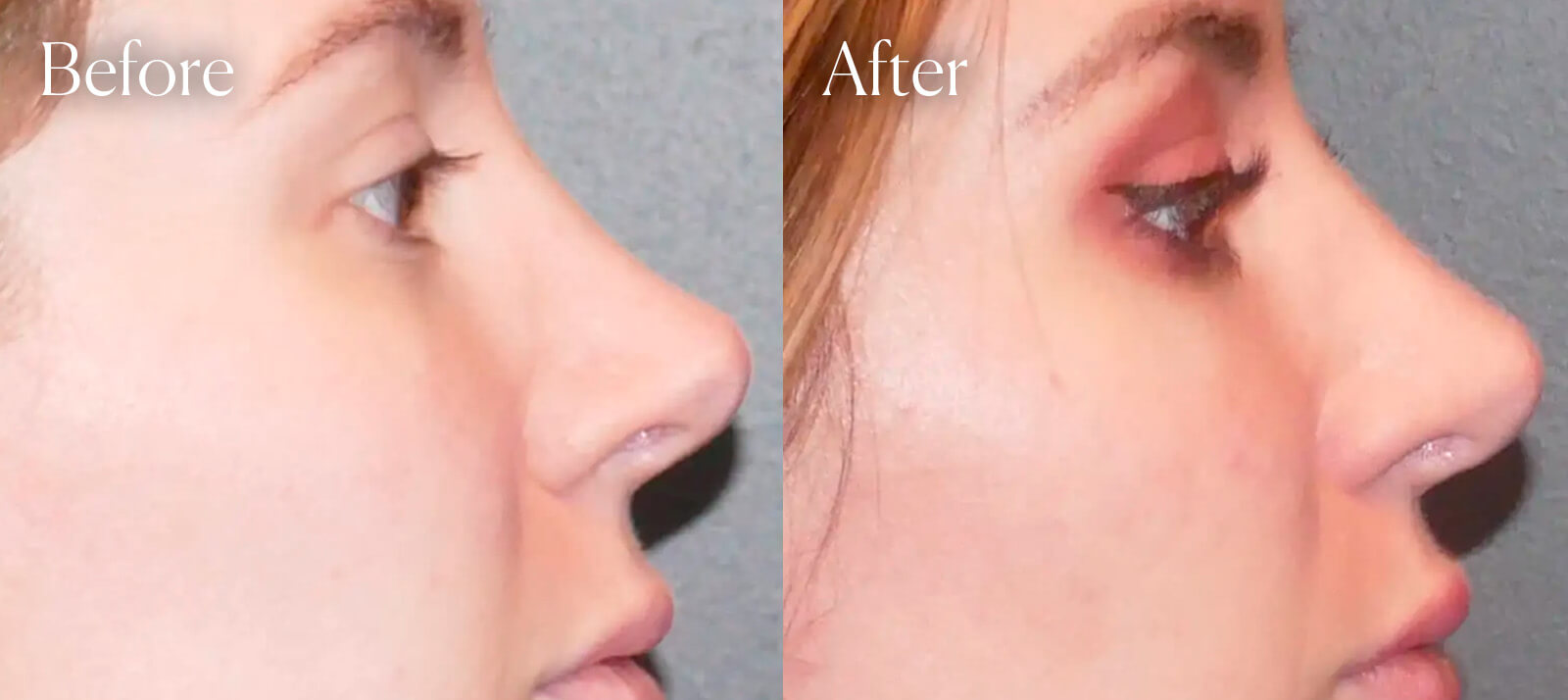 before-and-after-results-revision-rhinoplasty before and after results revision rhinoplasty
