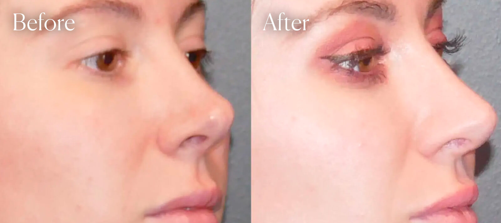 before-and-after-revision-rhinoplasty before and after revision rhinoplasty