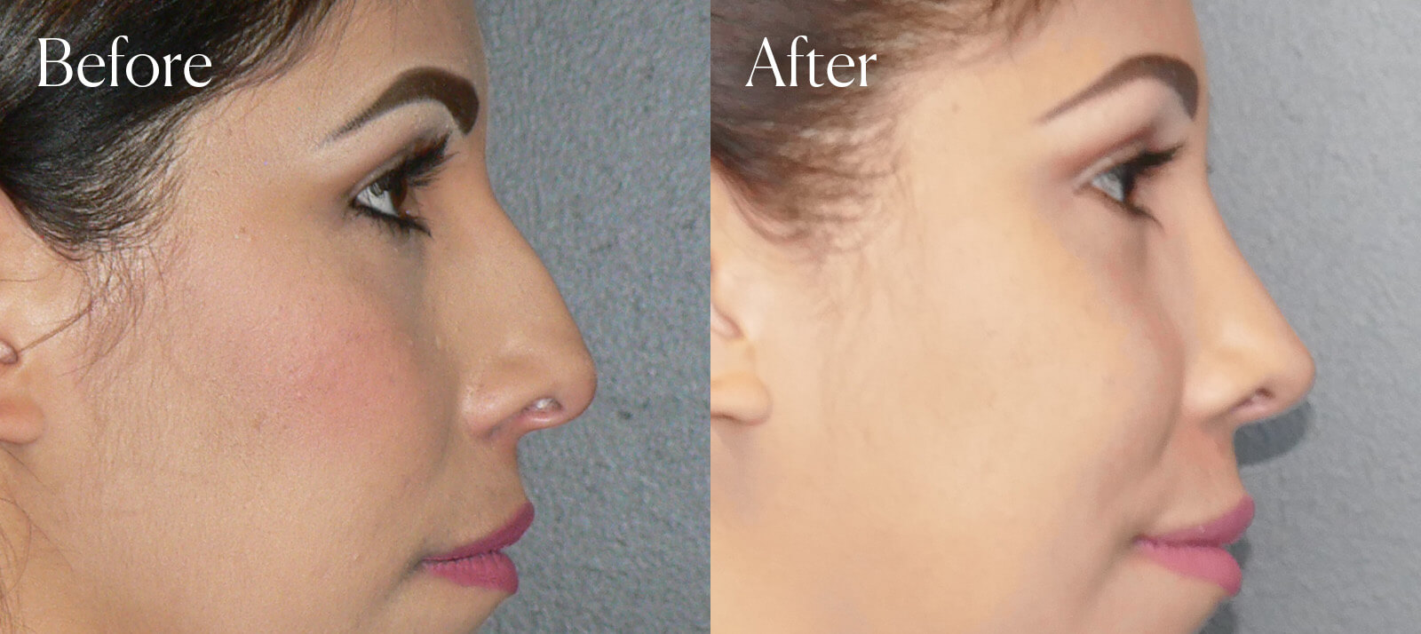 before-and-after-ultrasonic-ethnic-rhinoplasty before and after ultrasonic ethnic rhinoplasty