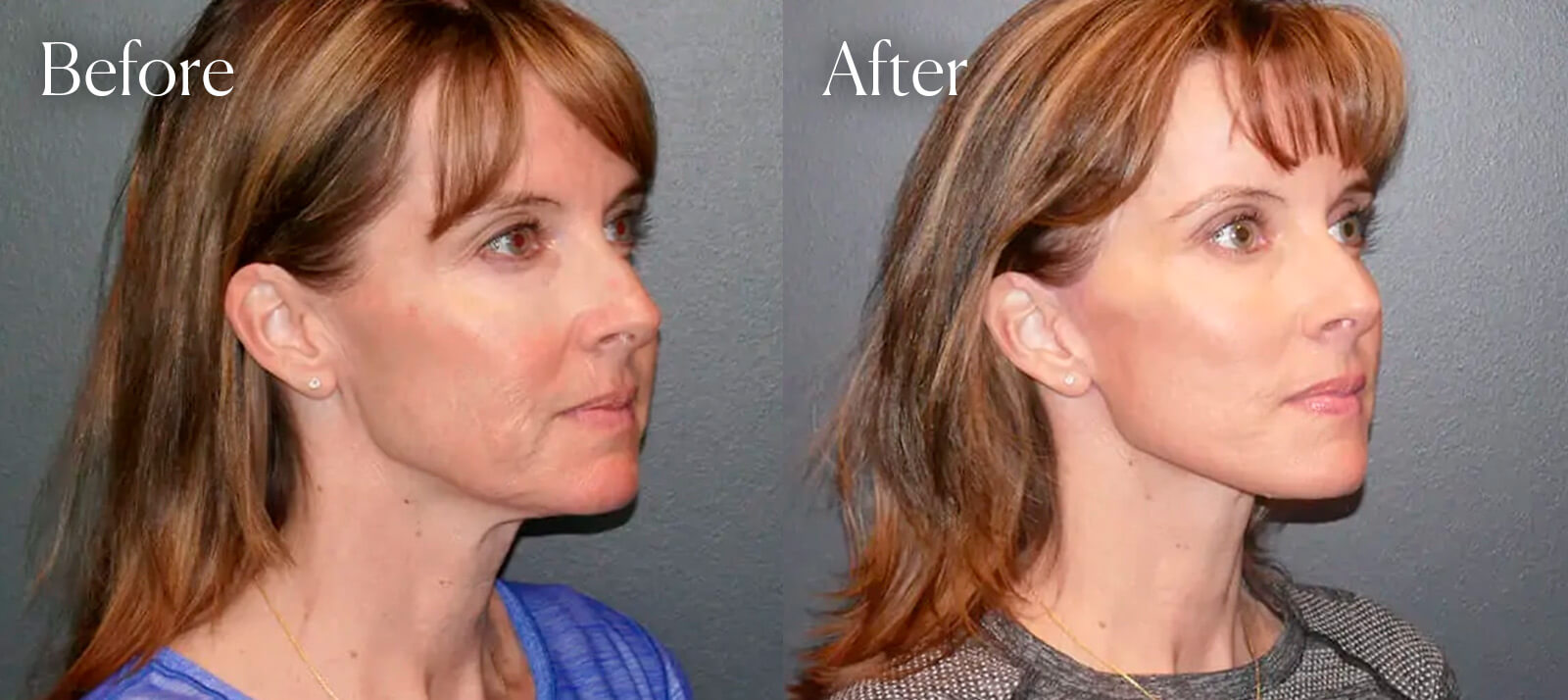 colorado-deep-plane-facelift colorado deep plane facelift