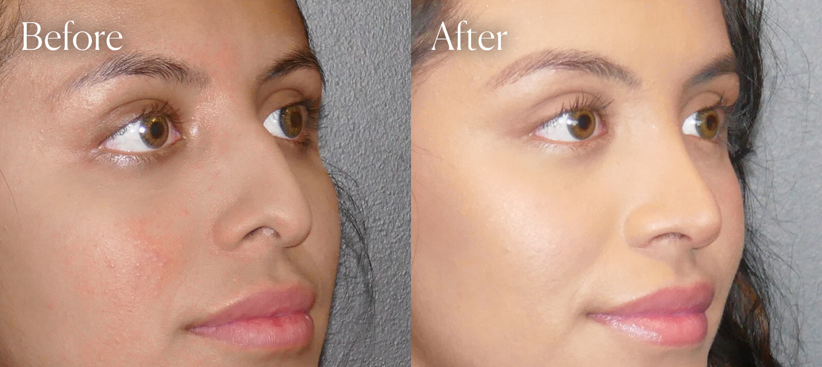 colorado-procedure-ethnic-rhinoplasty colorado procedure ethnic rhinoplasty