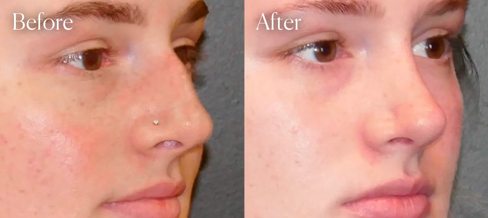 colorado-procedure-rhinoplasty colorado procedure rhinoplasty