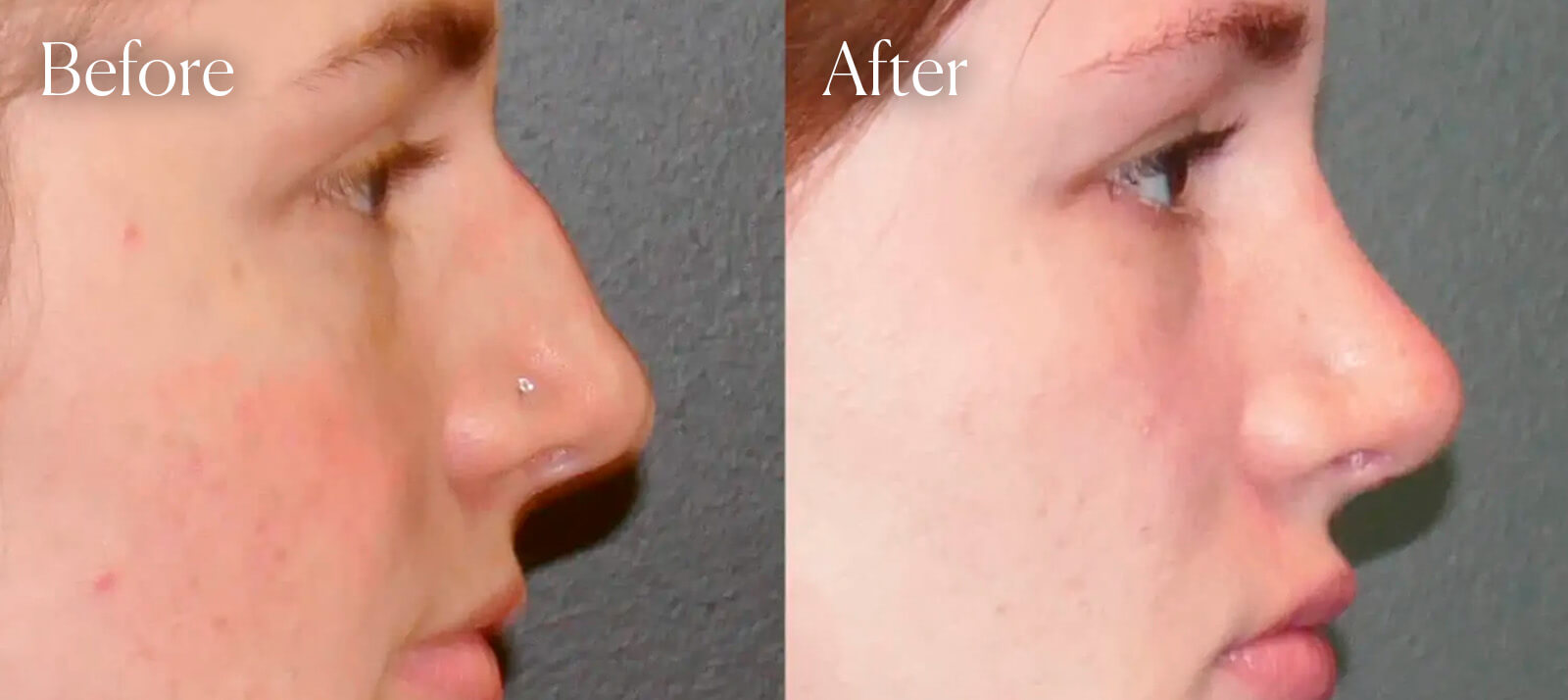colorado-rhinoplasty-procedure colorado rhinoplasty procedure