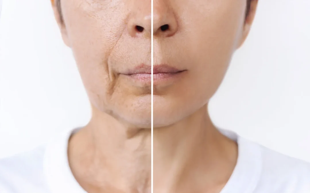 How Long Do Deep Plane Facelifts Last?