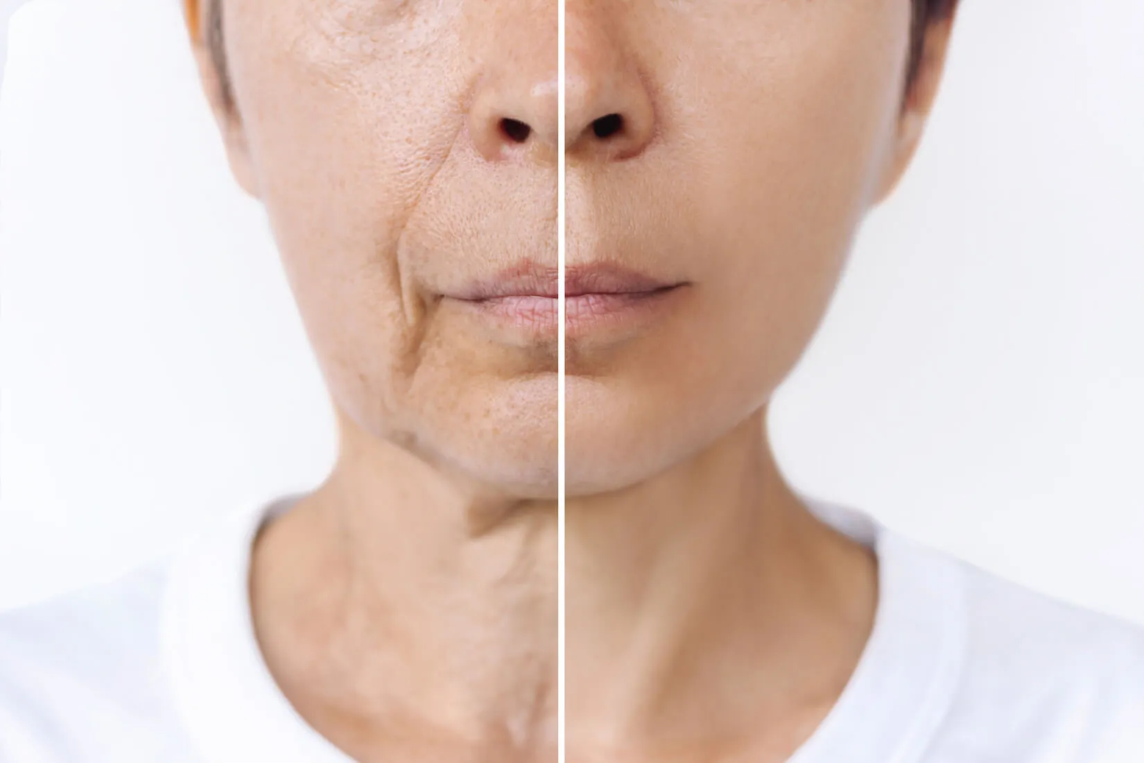 deep plane facelift longevity