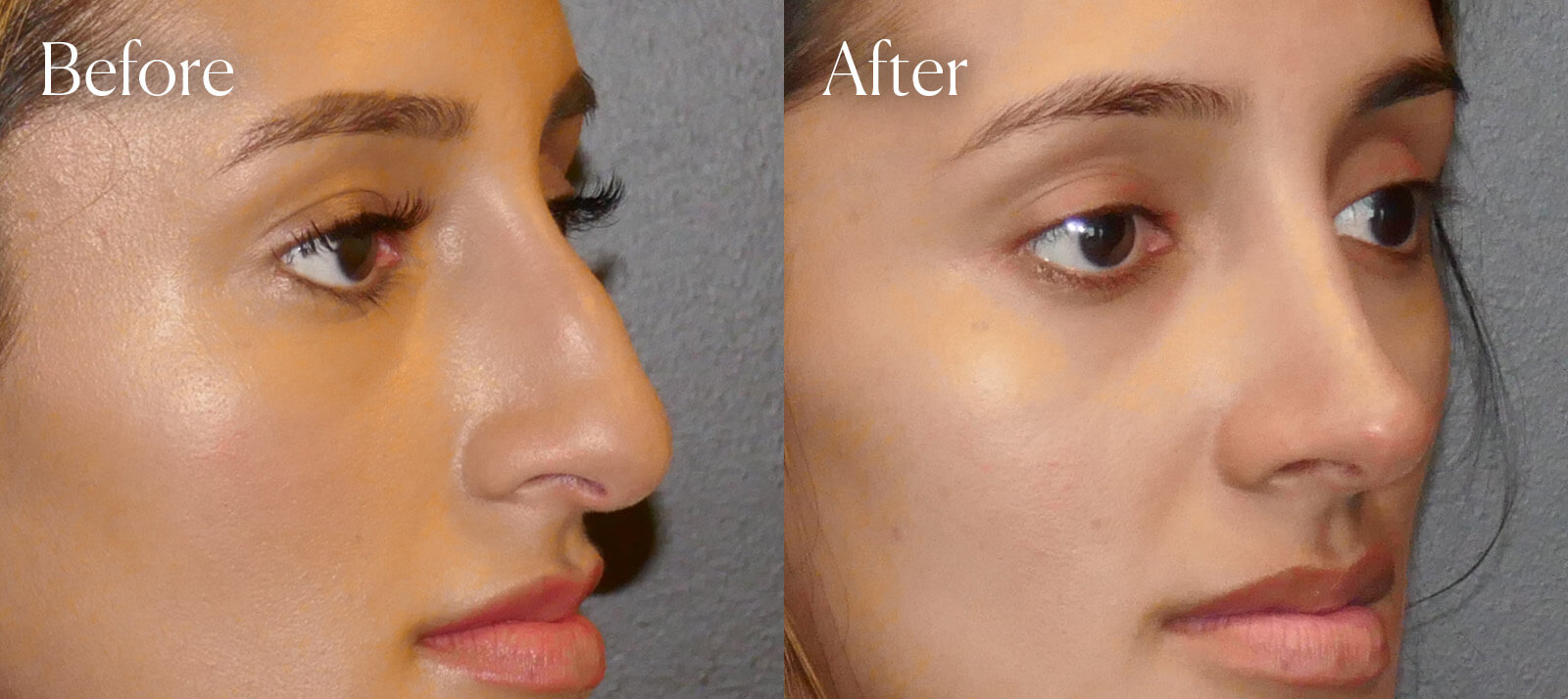 ethnic-facial-enhancements-ultrasonic-rhinoplasty ethnic facial enhancements ultrasonic rhinoplasty