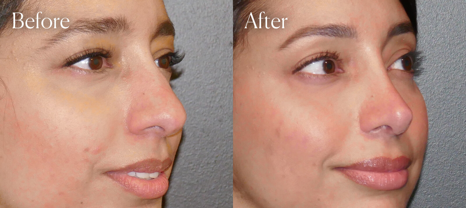 ethnic-plastic-surgery-ultrasonic-rhinoplasty ethnic plastic surgery ultrasonic rhinoplasty