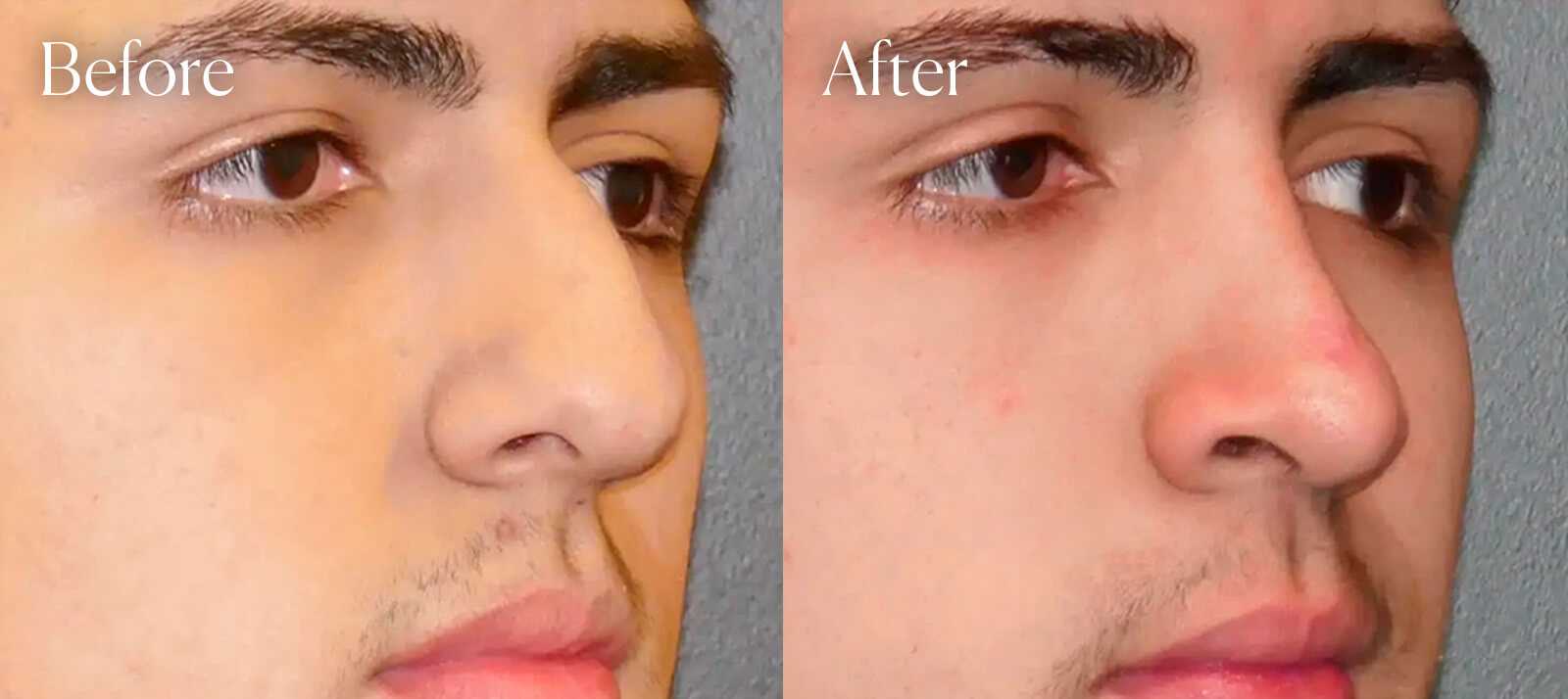 ethnic-surgery-results-ultrasonic-rhinoplasty ethnic surgery results ultrasonic rhinoplasty