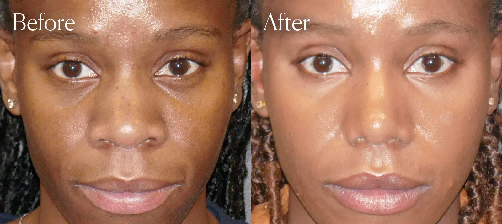 ethnic-ultrasonic-aesthetic-surgery-rhinoplasty ethnic ultrasonic aesthetic surgery rhinoplasty