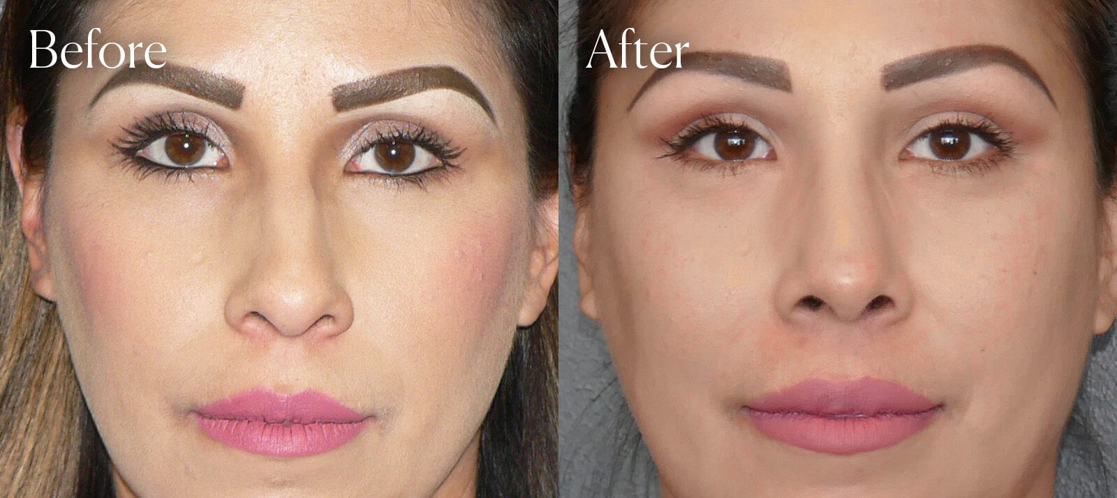 ethnic-ultrasonic-before-and-after-rhinoplasty ethnic ultrasonic before and after rhinoplasty