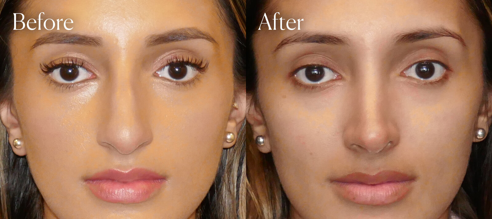 ethnic-ultrasonic-facial-enhancements-rhinoplasty ethnic ultrasonic facial enhancements rhinoplasty