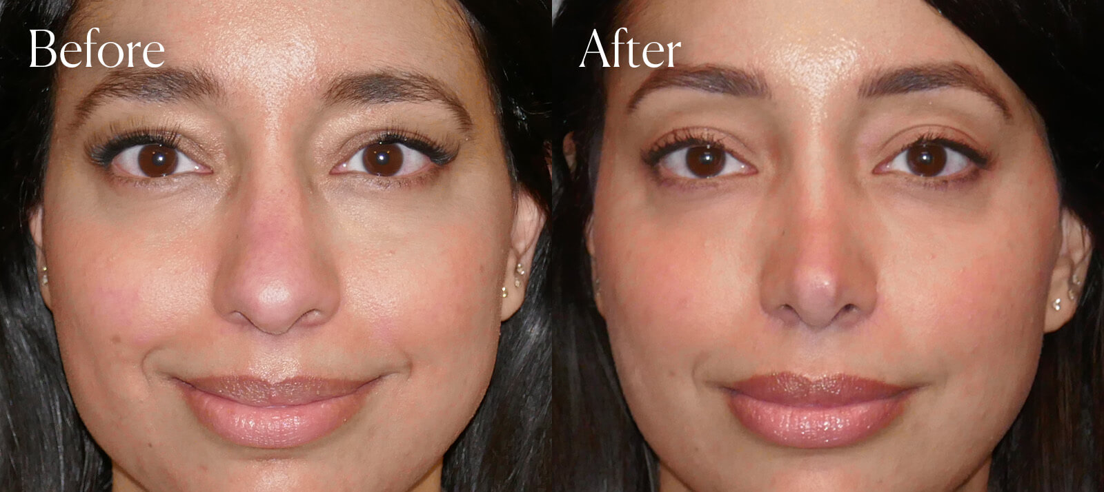 ethnic-ultrasonic-plastic-surgery-rhinoplasty ethnic ultrasonic plastic surgery rhinoplasty