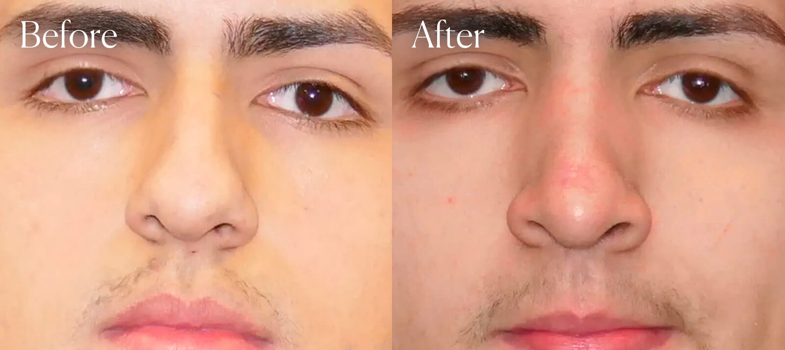 ethnic-ultrasonic-surgery-results-rhinoplasty ethnic ultrasonic surgery results rhinoplasty