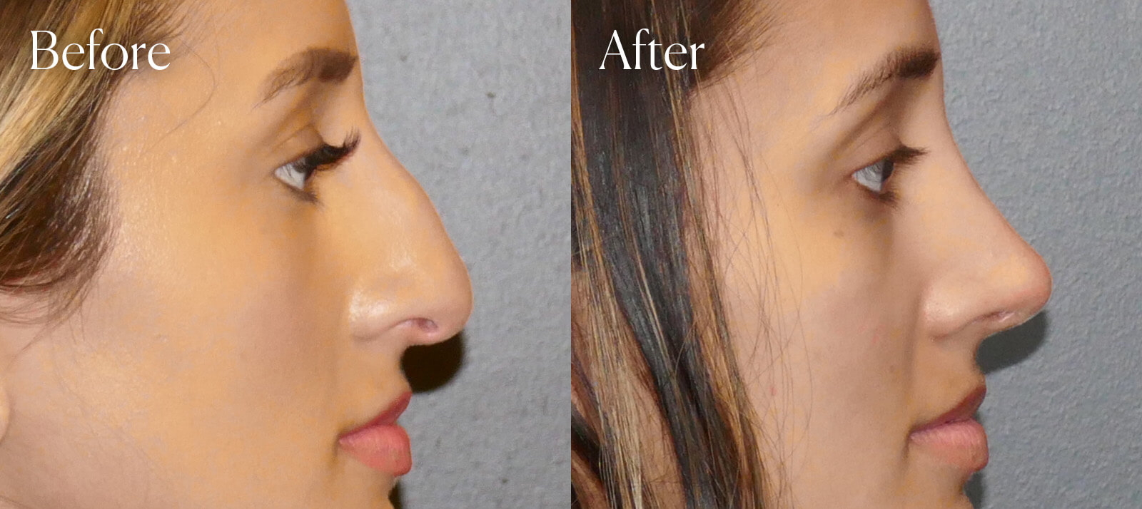 facial-enhancements-ethnic-ultrasonic-rhinoplasty facial enhancements ethnic ultrasonic rhinoplasty