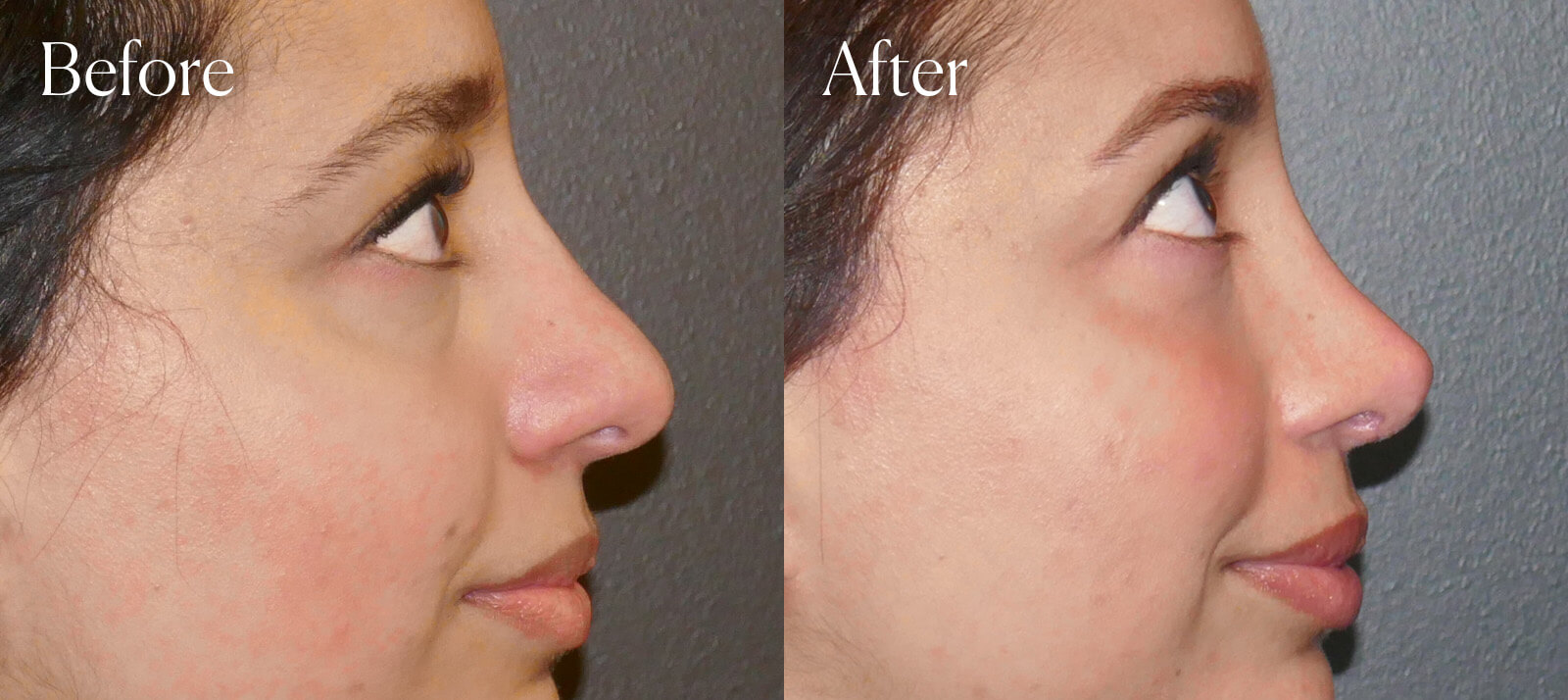 plastic-surgery-ethnic-ultrasonic-rhinoplasty plastic surgery ethnic ultrasonic rhinoplasty