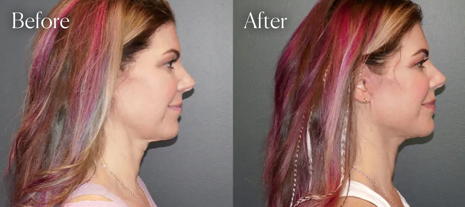 plastic-surgery-facelift-colorado-results plastic surgery facelift colorado results