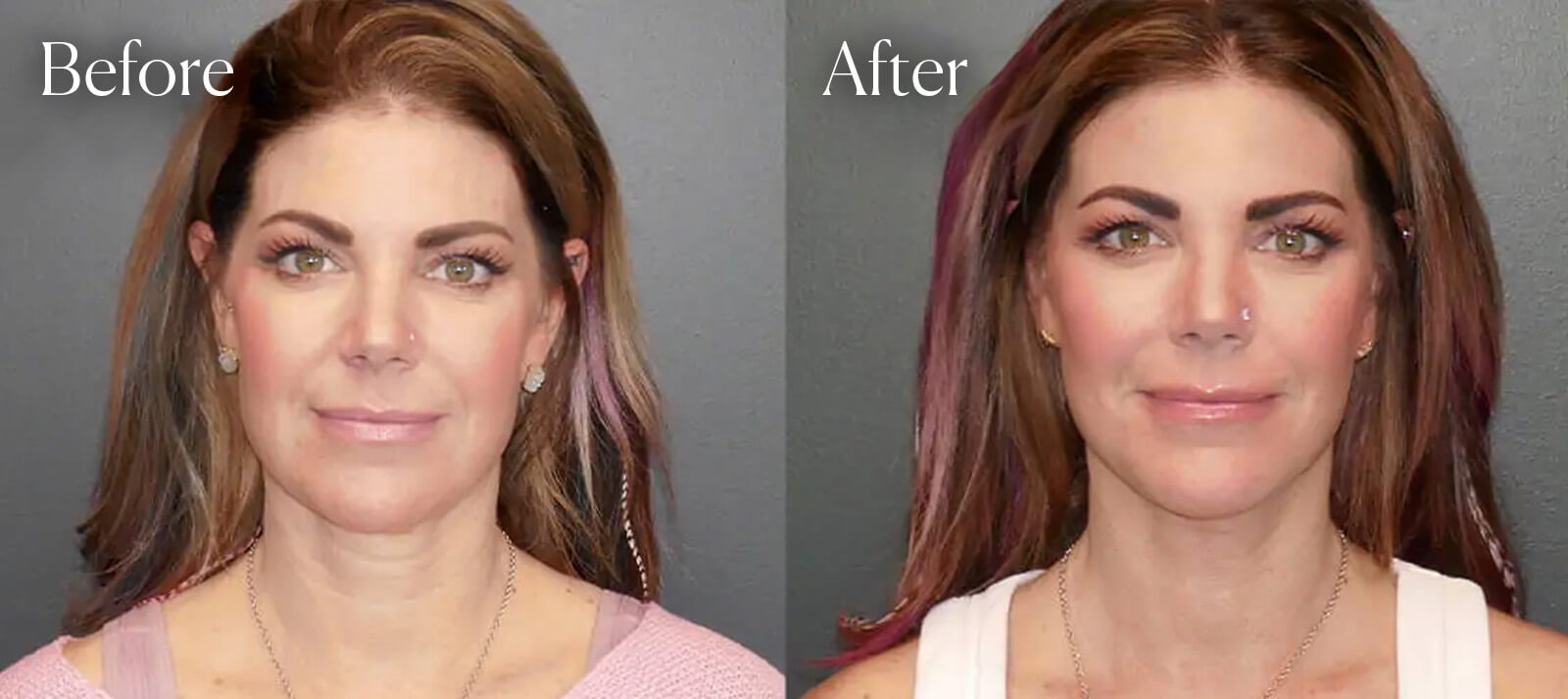 plastic-surgery-facelift-results plastic surgery facelift results