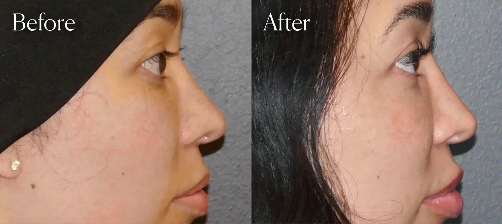 plastic-surgery-revision-ethnic-rhinoplasty-denver plastic surgery revision ethnic rhinoplasty denver
