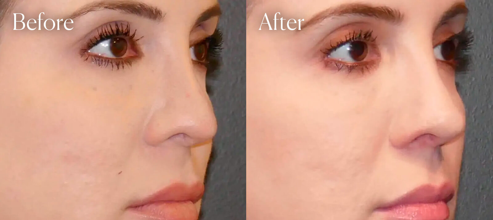 plastic-surgery-revision-rhinoplasty plastic surgery revision rhinoplasty