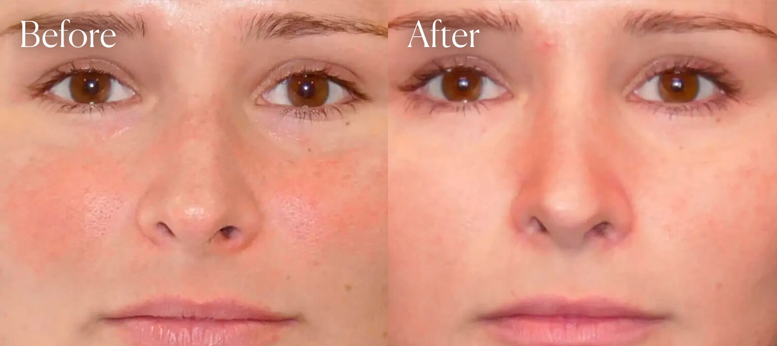 plastic-surgery-rhinoplasty plastic surgery rhinoplasty