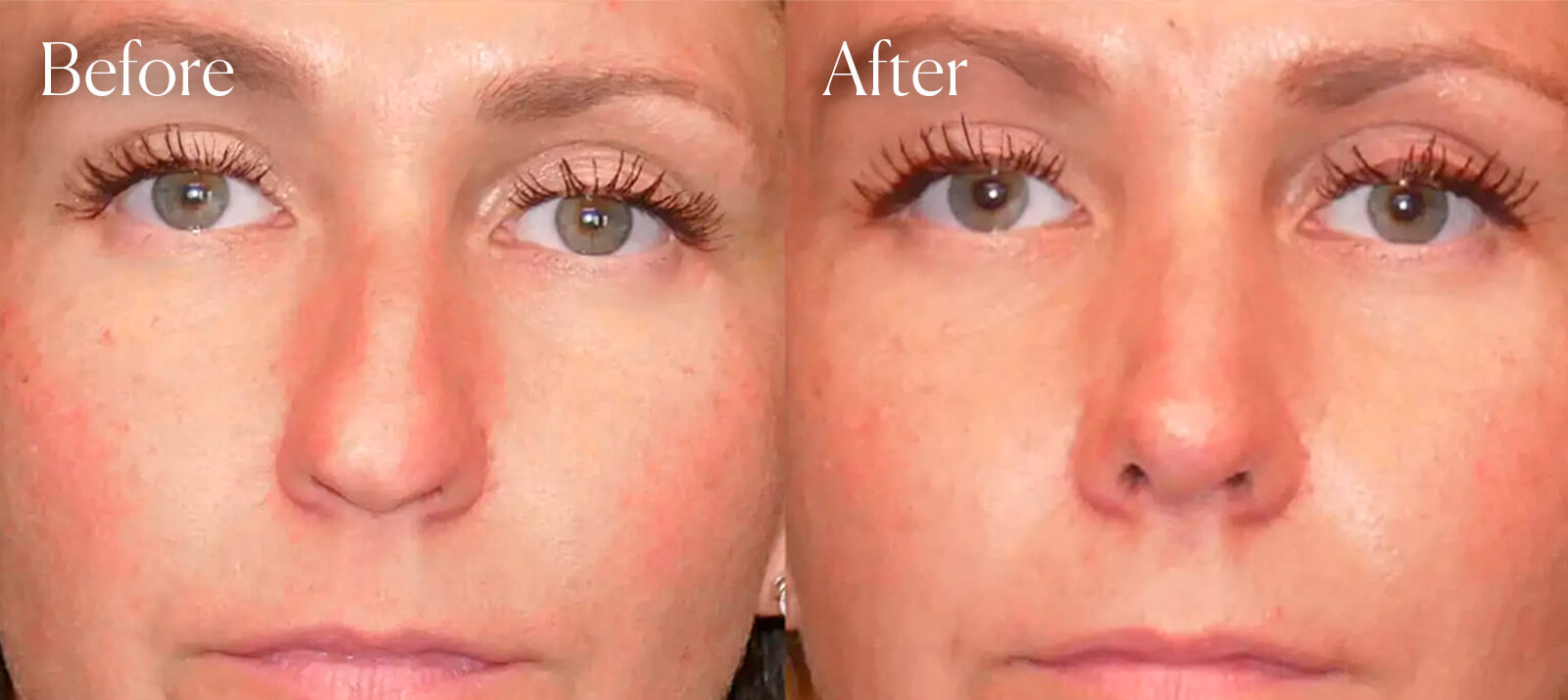 preservation-ultrasonic-aesthetic-surgery-rhinoplasty preservation ultrasonic aesthetic surgery rhinoplasty