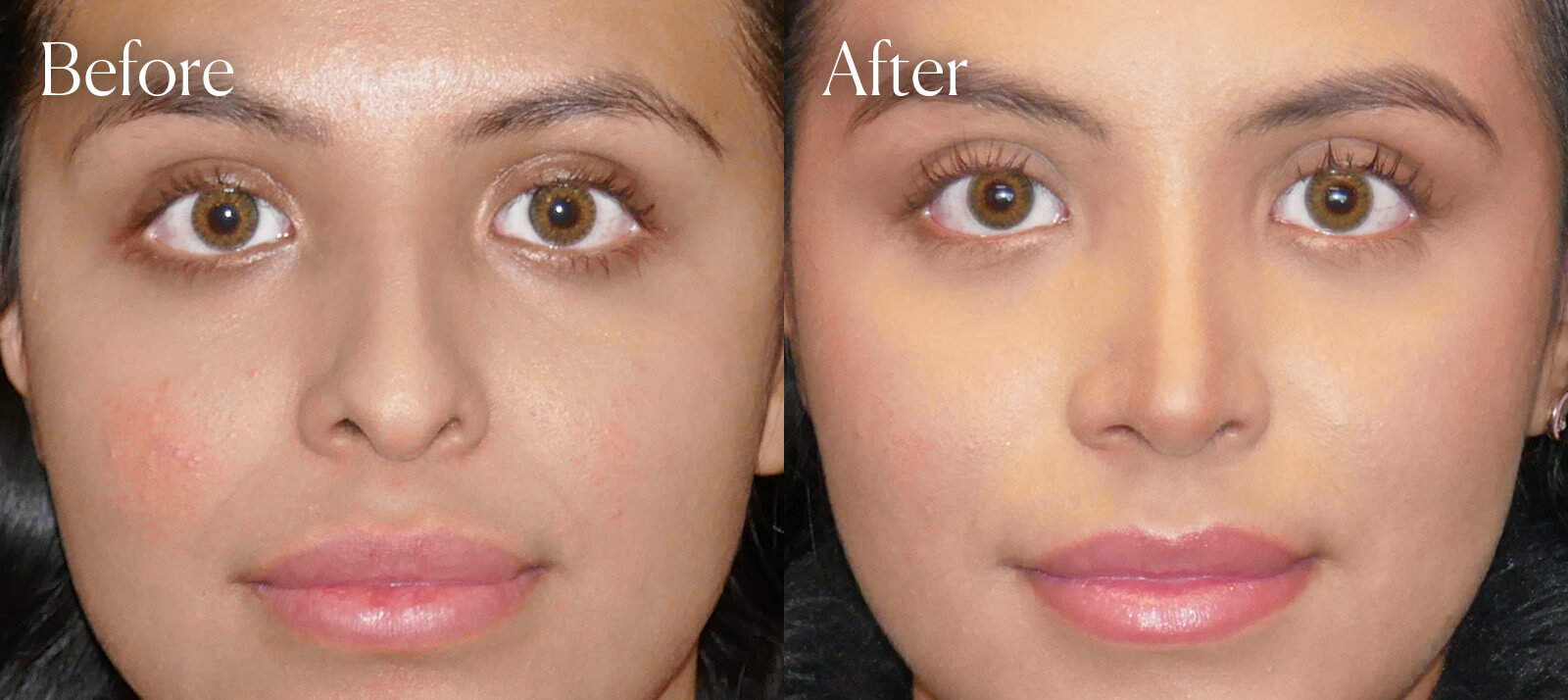 procedure-colorado-ethnic-rhinoplasty procedure colorado ethnic rhinoplasty