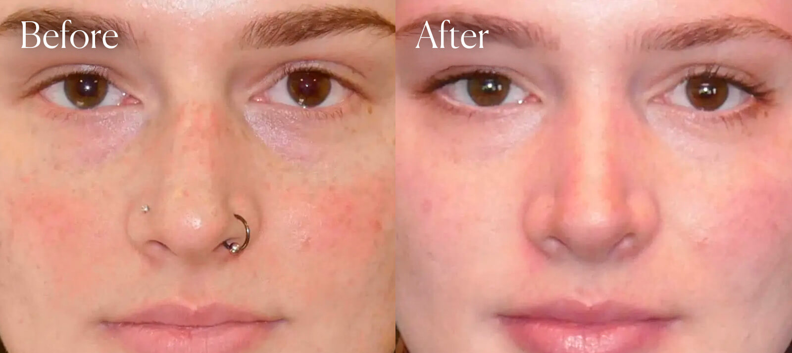 procedure-colorado-rhinoplasty procedure colorado rhinoplasty