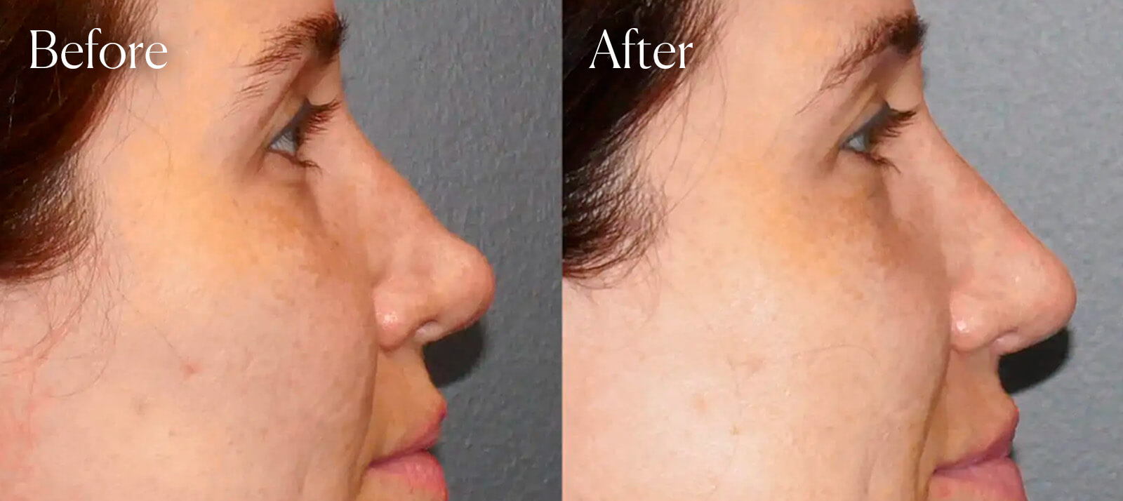procedure-colorado-tip-revision-rhinoplasty procedure colorado tip revision rhinoplasty