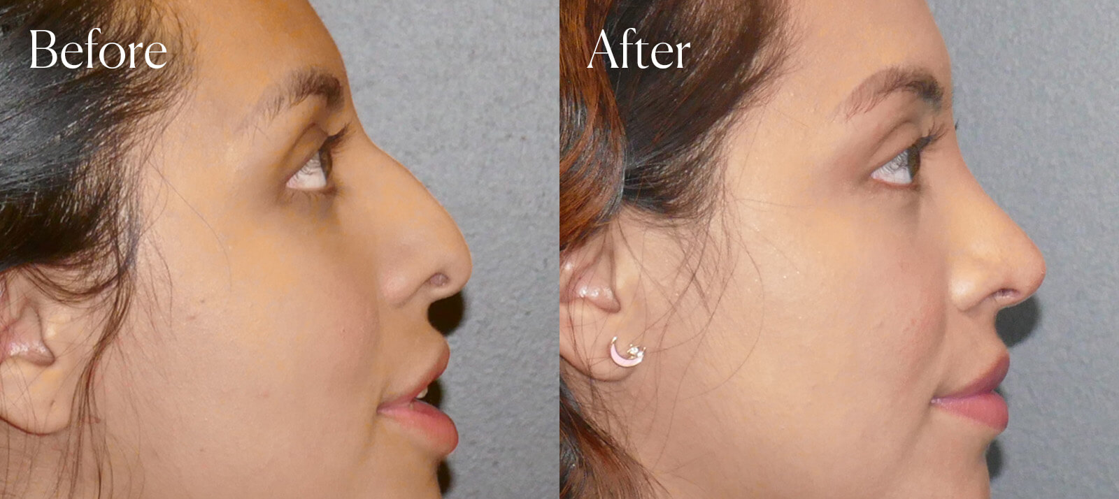 procedure-denver-colorado-ethnic-rhinoplasty procedure denver colorado ethnic rhinoplasty