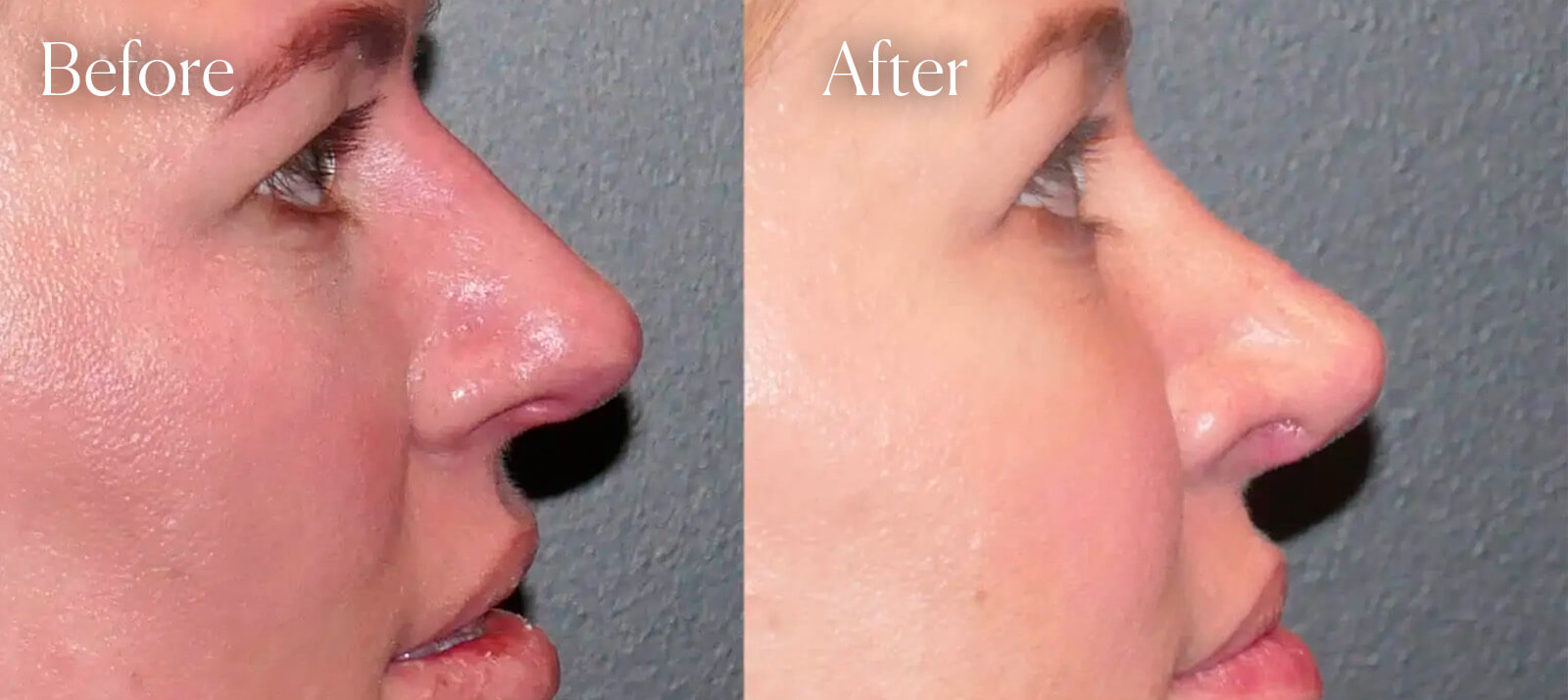 results-rhinoplasty-surgery results rhinoplasty surgery