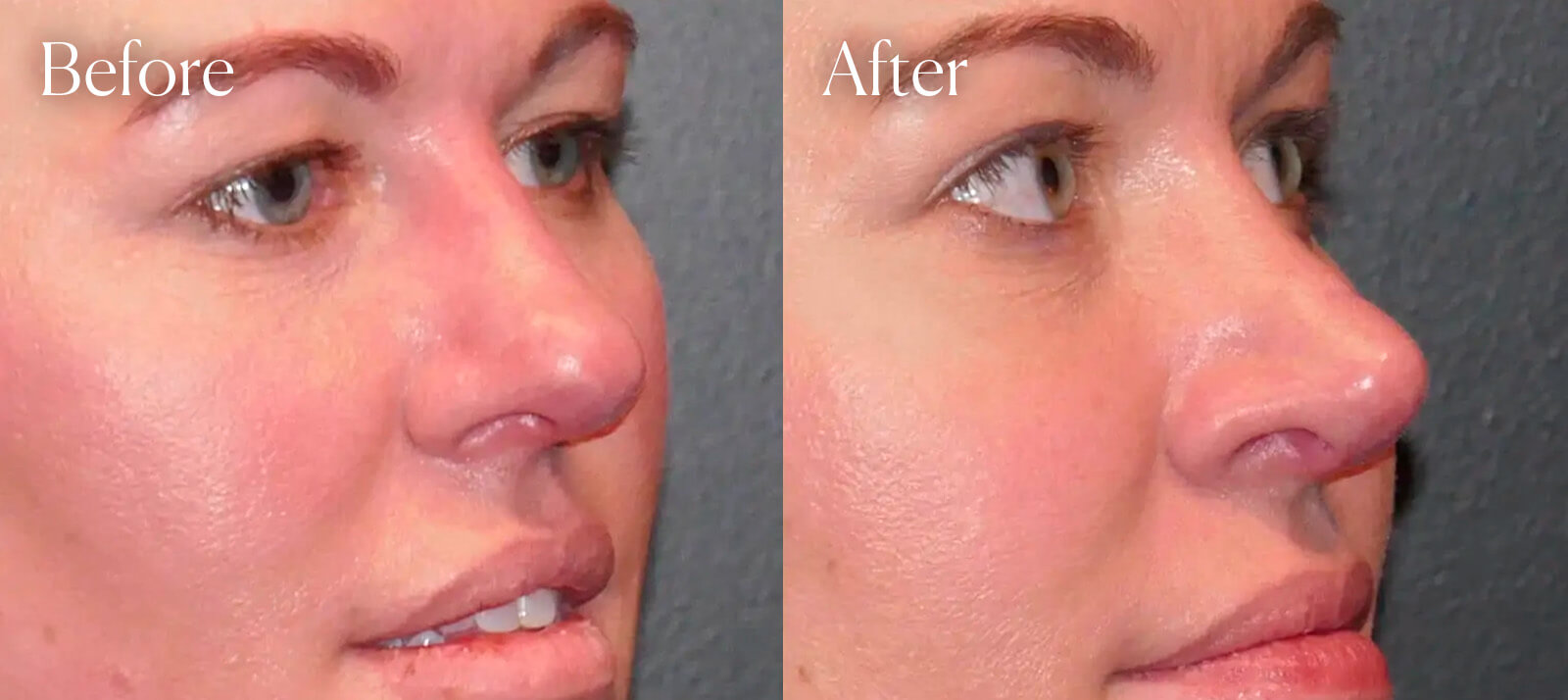 results-surgery-rhinoplasty results surgery rhinoplasty